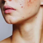 Clear Skin Ahead: Tested Home Remedies for Acne